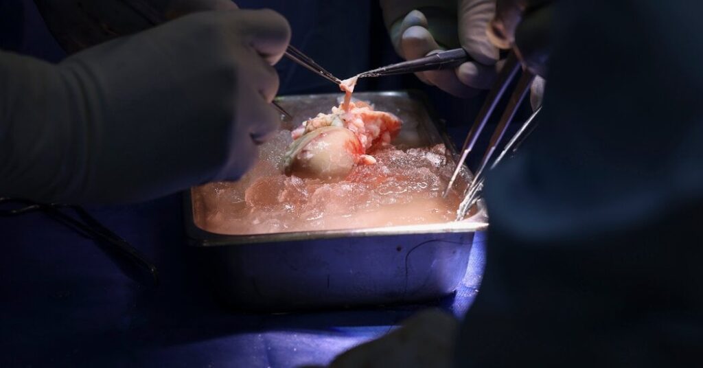 Patient mit transplantierter Schweineniere verlässt das Krankenhaus und geht nach Hause