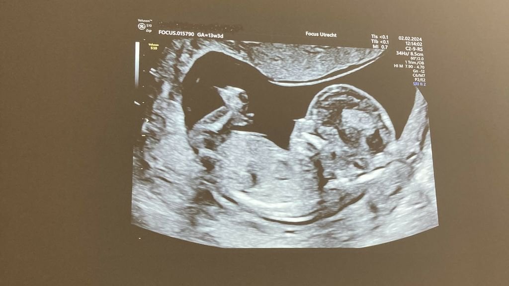Parvovirus breitet sich aus, ein Risiko für schwangere Frauen