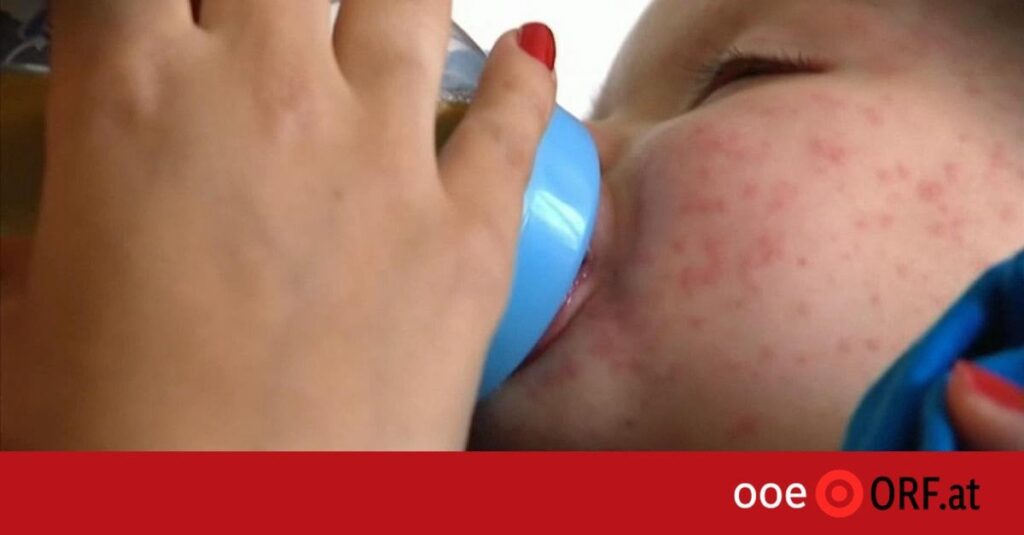 Masernfälle in OÖ sprunghaft angestiegen