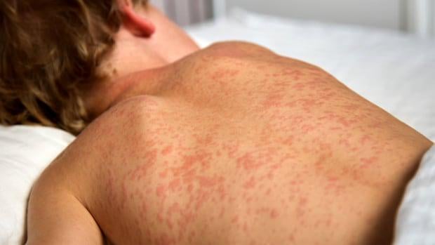 Warum steigen Masernfallzahlen in Alberta so hoch? Experten wiegen
