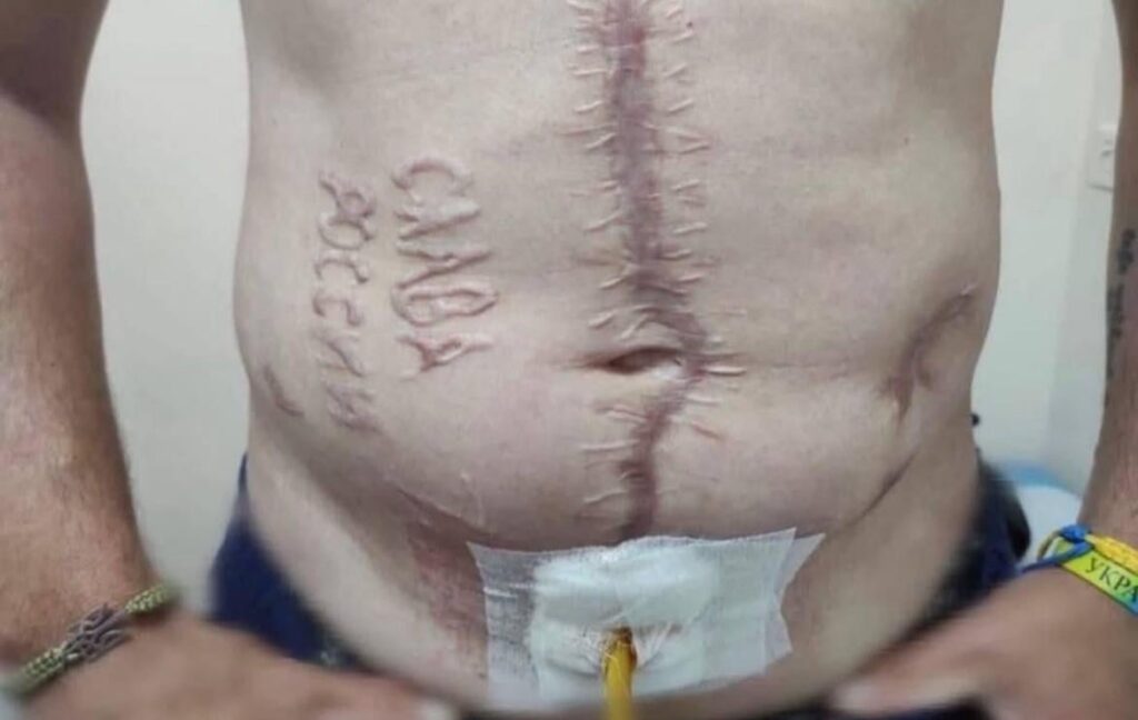 Ein ukrainischer Soldat, der aus russischer Gefangenschaft entlassen wird, enthüllt Anzeichen brutaler Folter. Sein Körper ist mit Verstümmelungen und ausgebrannten Worten bedeckt: "Ehre zu Russland".