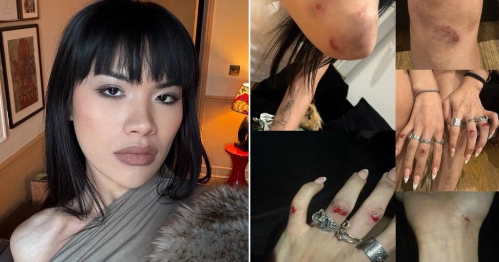 Transfrau "mit Blut und Blutergüssen bedeckt" nach transphobischem Angriff auf die Straße