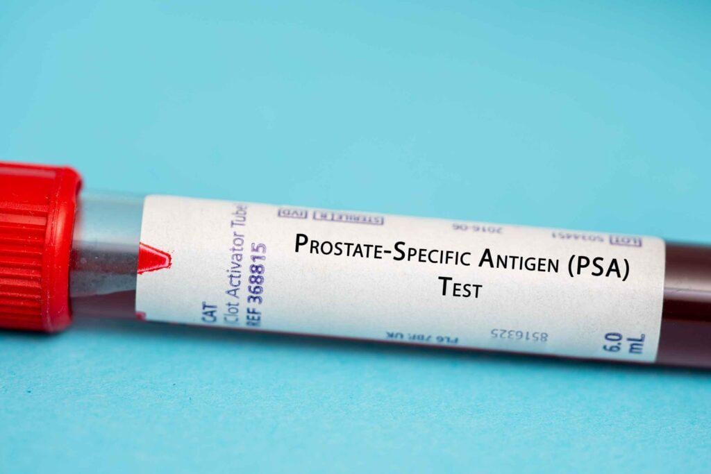Dänische Wissenschaftler finden frühzeitig Prostatakrebs