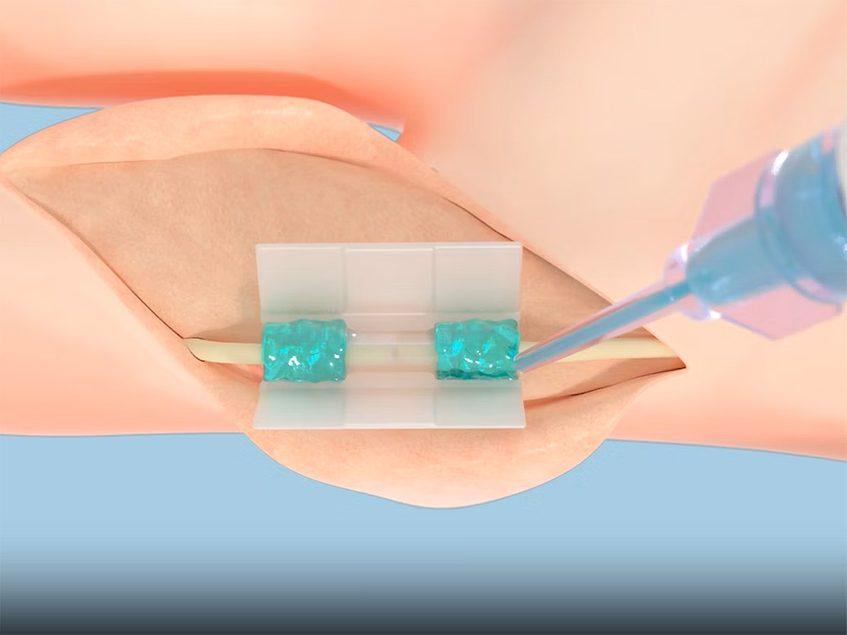 Die Polymerlösung von Tissium, die zur Transformation der Nervenreparatur nach FDA -Nicken eingestellt ist