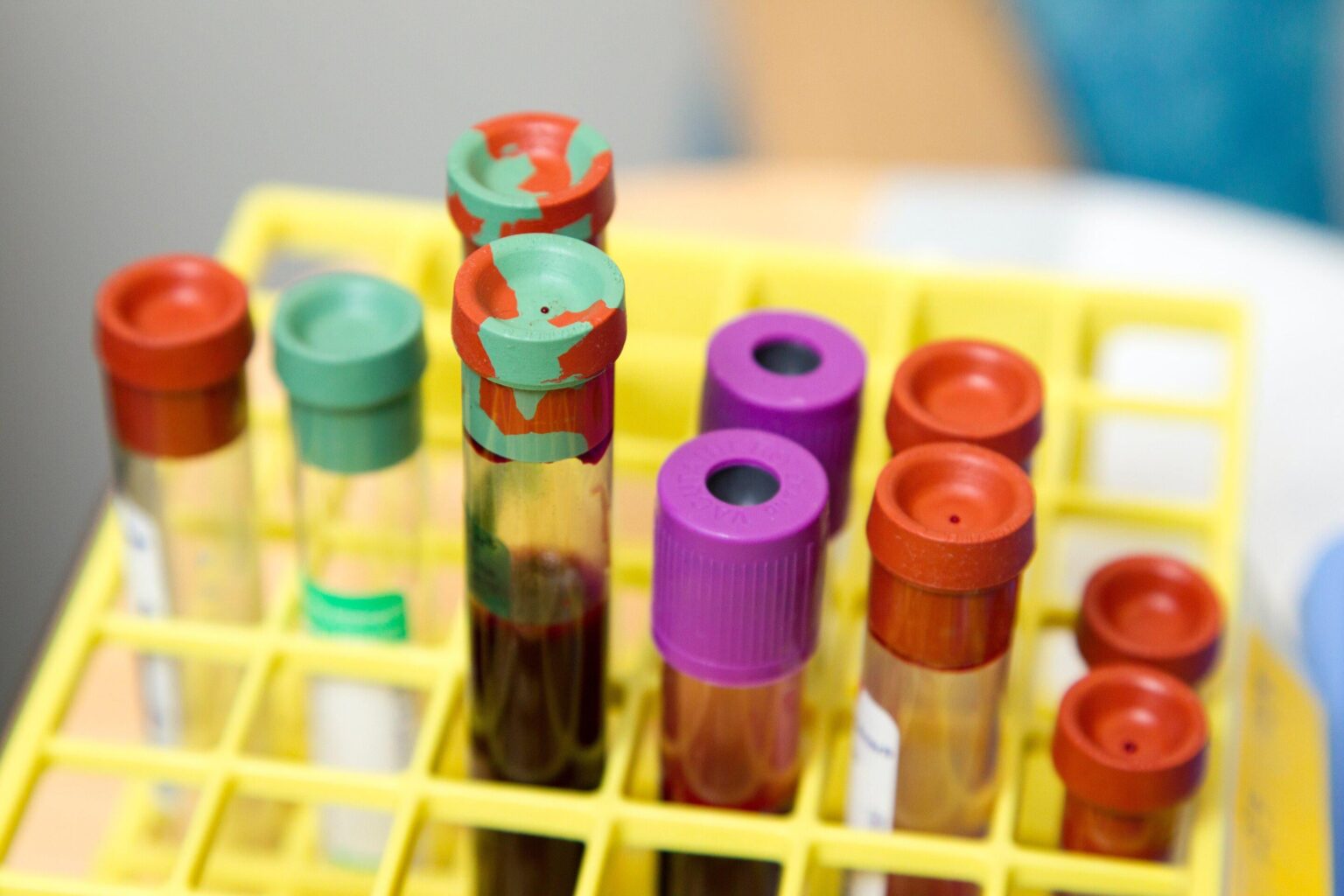 Jugendliche mit höheren Blutspiegeln von PFAs gewinnen nach einer bariatrischen Operation mehr Gewicht zurück. Viele Menschen, die eine bariatrische Chirurgie erhalten, wiederholen im Laufe der Zeit ein erhebliches Gewicht, was die langfristigen gesundheitlichen Vorteile des Verfahrens einschränken kann. Jugendliche mit höheren Blutspiegeln von PFAs gewinnen nach einer bariatrischen Operation mehr Gewicht zurück. Viele Menschen, die eine bariatrische Chirurgie erhalten, wiederholen im Laufe der Zeit ein erhebliches Gewicht, was die langfristigen gesundheitlichen Vorteile des Verfahrens einschränken kann.