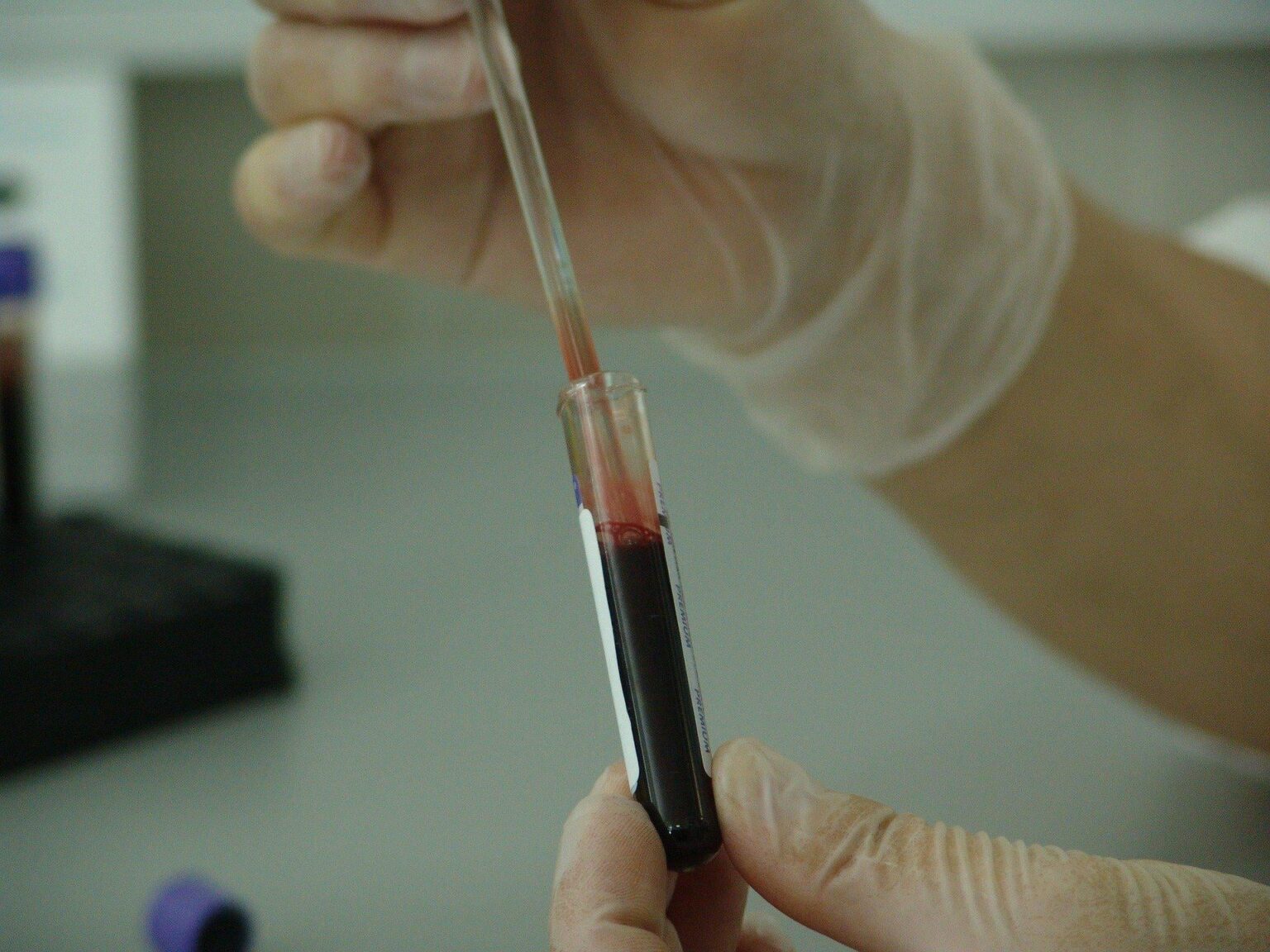 Die Forscher identifizieren einen potenziellen Biomarker für lange Covid