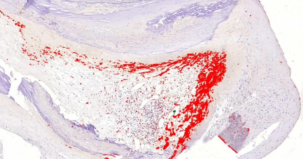 Myokardinfarkt kann eine infektiöse Erkrankung sein: Die Studie zeigte das Vorhandensein von DNA aus mehreren oralen Bakterien innerhalb atherosklerotischer Plaques. Das Immunsystem des Körpers reagierte auf diese Bakterien und löste eine Entzündung aus, die die cholesterinbeladene Plaque baute. Myokardinfarkt kann eine infektiöse Erkrankung sein: Die Studie zeigte das Vorhandensein von DNA aus mehreren oralen Bakterien innerhalb atherosklerotischer Plaques. Das Immunsystem des Körpers reagierte auf diese Bakterien und löste eine Entzündung aus, die die cholesterinbeladene Plaque baute.