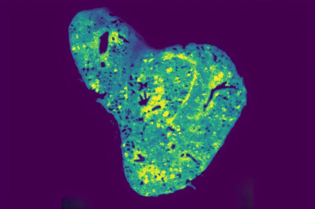 Glutathion: Mitochondriales Antioxidans, die Brustkrebsmetastasierung vorantreiben