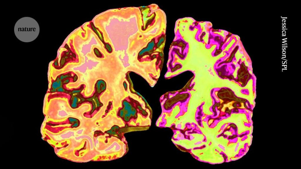 Neue Hoffnung für Alzheimer: Lithium -Supplement kehrt den Gedächtnisverlust bei Mäusen um
