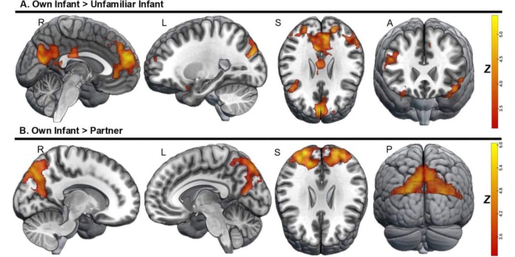 Seit über 20 Jahren untersucht Wissenschaftler, wie Mütter auf das Betrachten ihres eigenen Kindes reagieren. Im Vergleich zu Müttern haben weit weniger Studien Väter untersucht. Eine neue Studie zeigt Hinweise darauf, dass die Vaterschaft das Gehirn auch auf eine Weise umgestaltet, die eine sensible Pflege unterstützen kann. Seit über 20 Jahren untersucht Wissenschaftler, wie Mütter auf das Betrachten ihres eigenen Kindes reagieren. Im Vergleich zu Müttern haben weit weniger Studien Väter untersucht. Eine neue Studie zeigt Hinweise darauf, dass die Vaterschaft das Gehirn auch auf eine Weise umgestaltet, die eine sensible Pflege unterstützen kann.