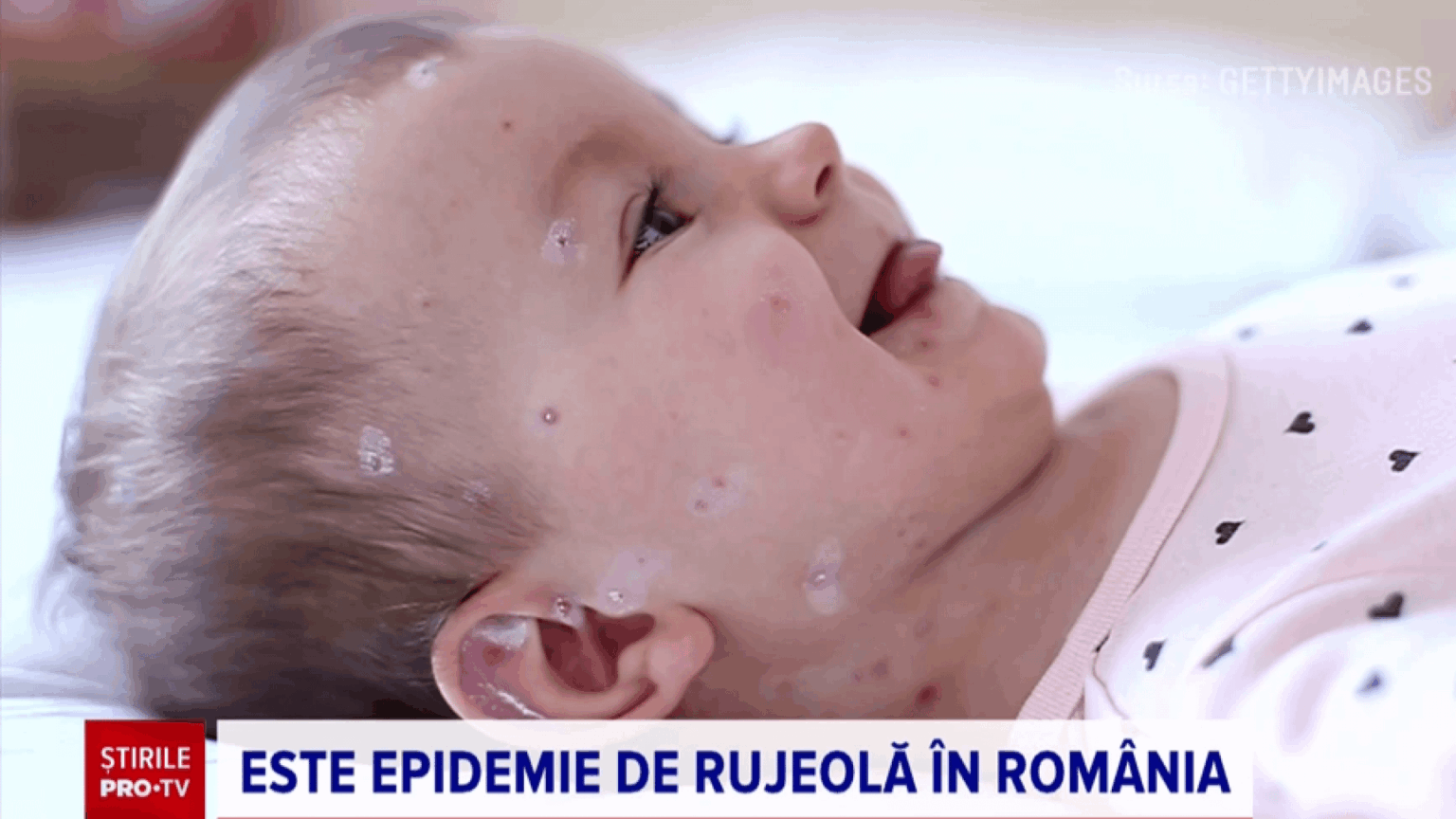 Rumänien, europäischer Masernausbruch: acht Todesfälle und 13.000 Fälle pro Jahr. Impfrate 62% Rumänien, europäischer Masernausbruch: acht Todesfälle und 13.000 Fälle pro Jahr. Impfrate 62%