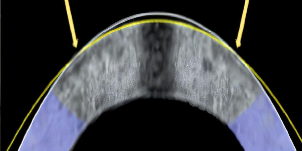 Eine neue Augenformtechnik könnte LASIK ersetzen