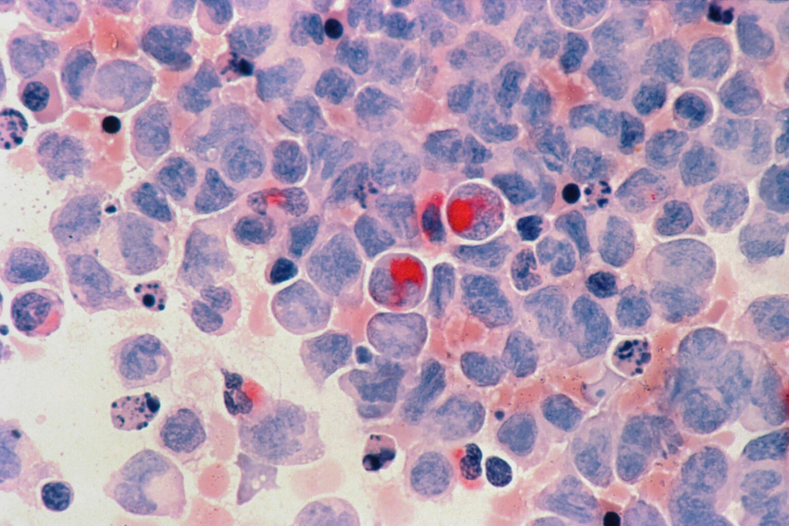 Wie ein einzelnes Protein Leukämiezellen neu verdreht, um sein Wachstum zu stärken