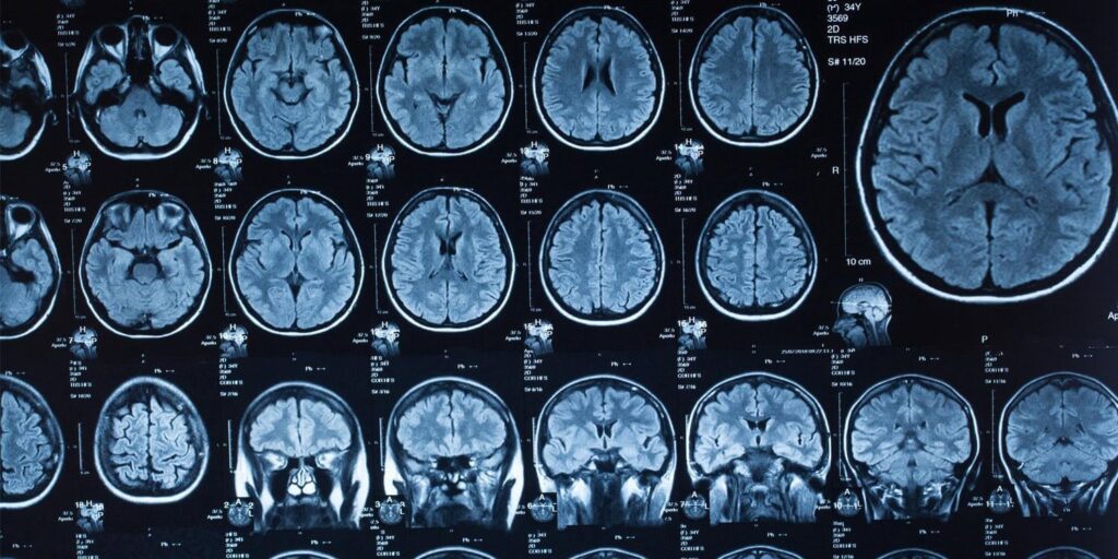 Personen, die eine schnellere biologische Alterung haben, haben ein erhöhtes Risiko für Demenz. Diejenigen mit der am stärksten beschleunigten biologischen Alterung und der ApoE ε4 -Genvariante hatten ein 4,2 -mal höheres Demenzrisiko als Personen mit der langsamsten biologischen Alterung und ohne diese Genvariante.