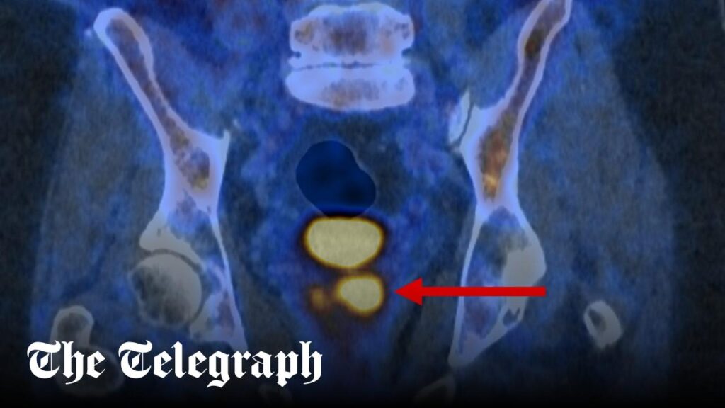 Männer verlieren Anspruch auf Prostatakrebstest
